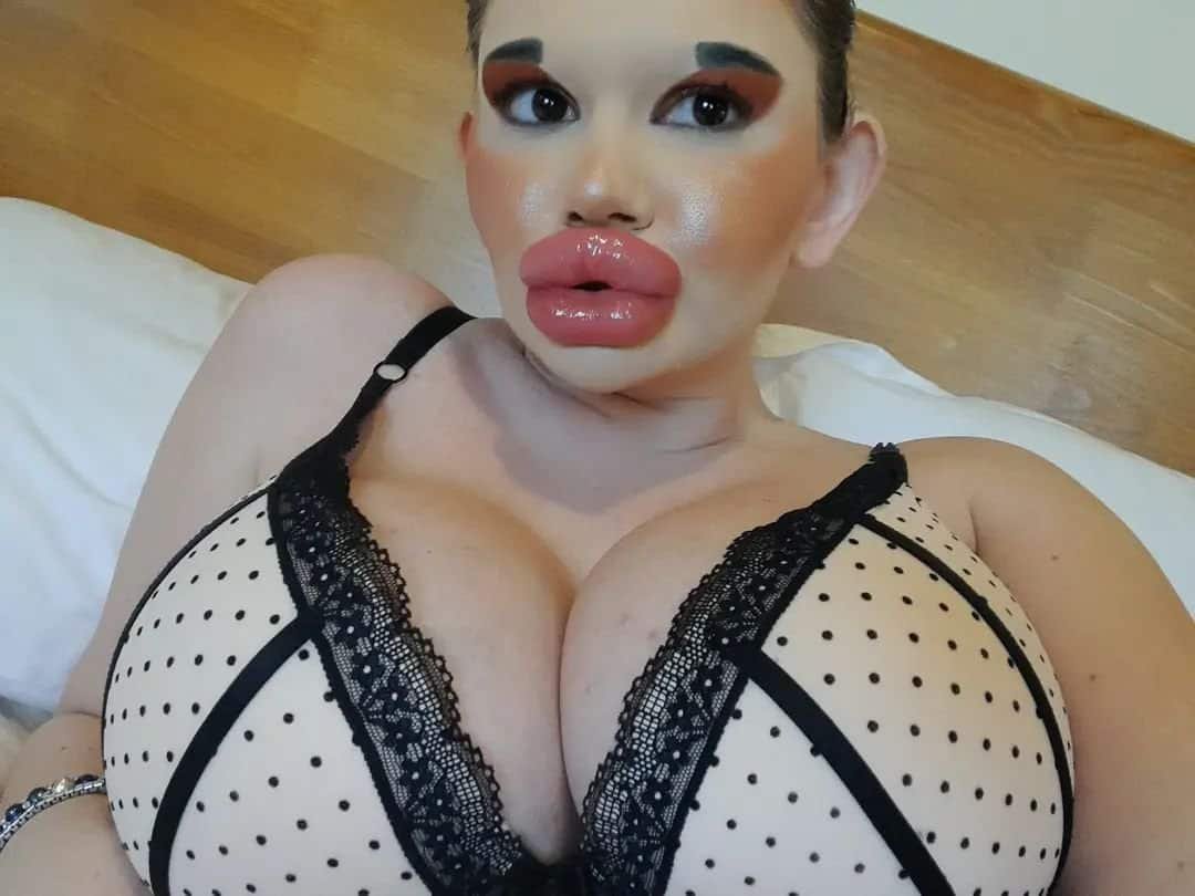 Andrea Ivanova, The Woman Who Did 27 Procedures To Achieve ‘World’s Biggest Lips’